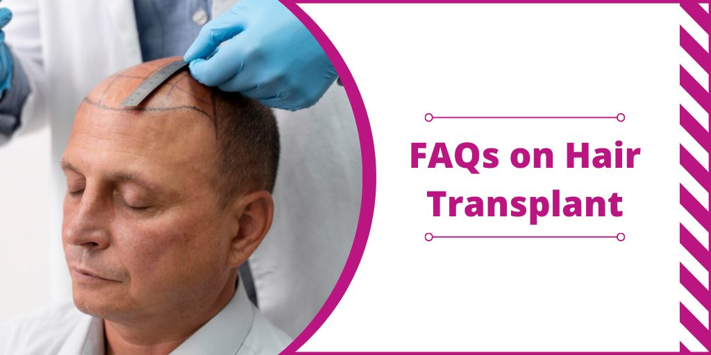 FAQs on Hair Transplant