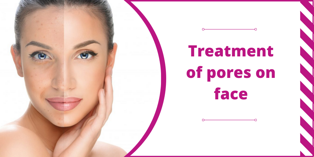 Treatment of pores on face