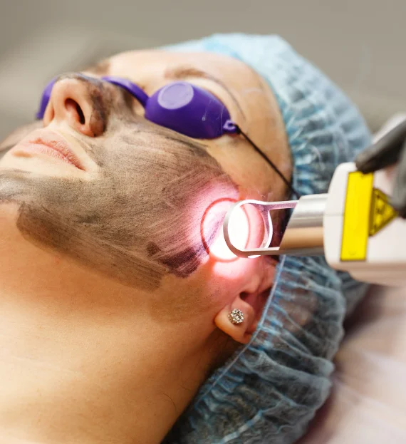 Q Switched nd Yag Laser Treatment in Sarjapur Road | SK Truderma