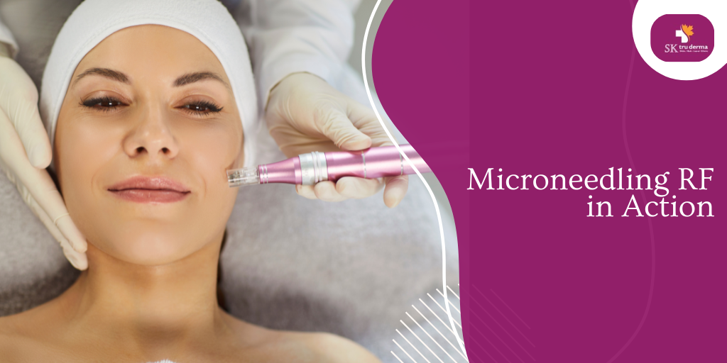 Microneedling RF in Action