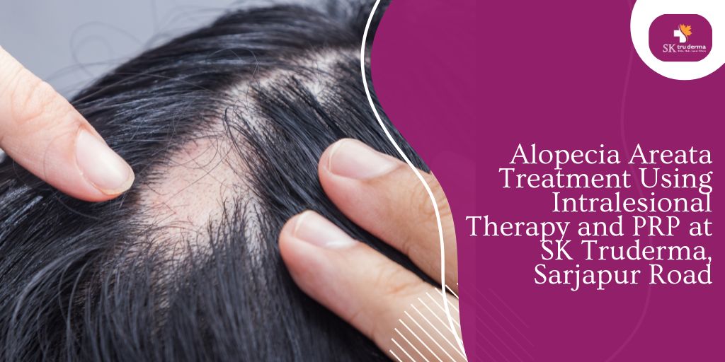 Alopecia Areata Treatment Using Intralesional Therapy and PRP at SK Truderma, Sarjapur Road