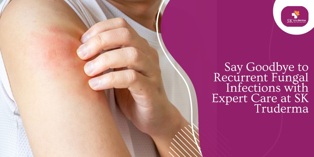 Say Goodbye to Recurrent Fungal Infections with Expert Care at SK Truderma
