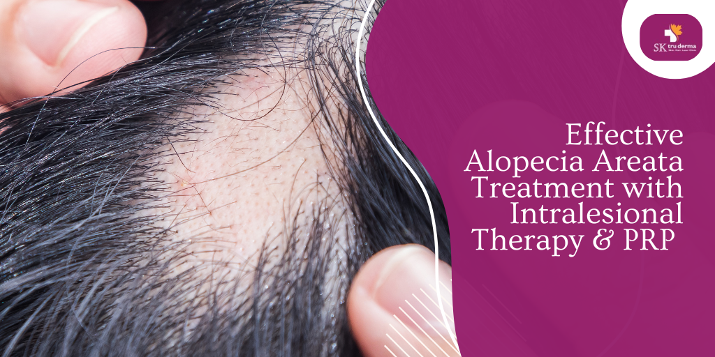 Effective Alopecia Areata Treatment with Intralesional Therapy & PRP | PRP treatment in Sarjapur Road