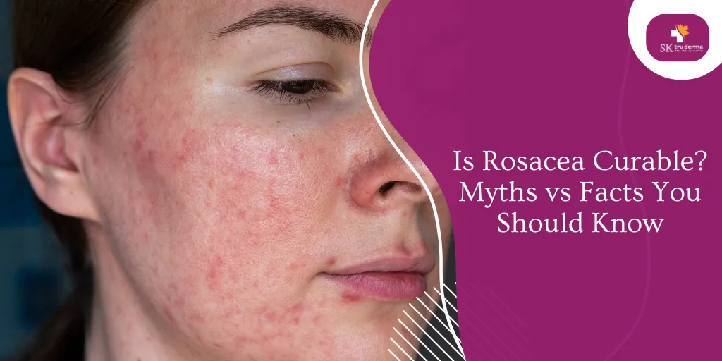Is Rosacea Curable? Myths vs Facts You Should Know | Dermatologist in Gunjur