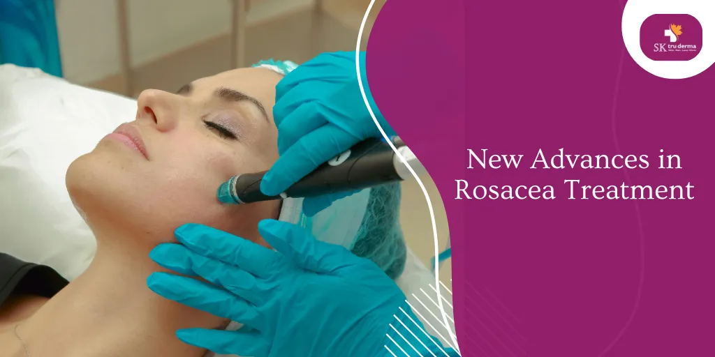 New Advances in Rosacea Treatment | Skincare Clinic in Gunjur