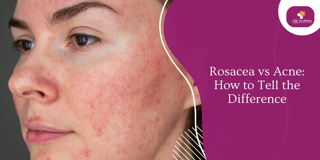 Rosacea vs Acne: How to Tell the Difference | Skincare Clinic Near Gunjur
