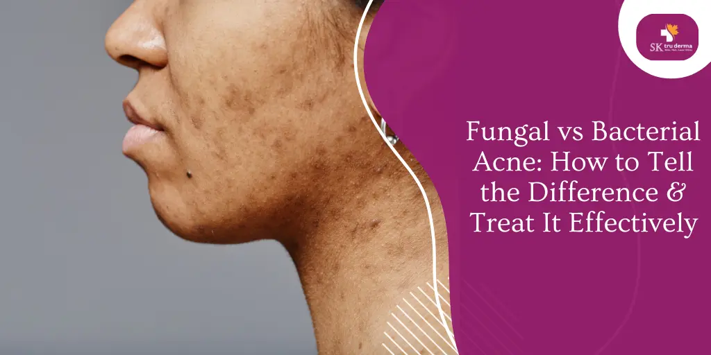 Fungal vs Bacterial Acne: How to Tell the Difference & Treat It Effectively | Dermatologist Near Gunjur Road