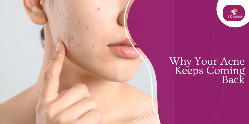 Why Your Acne Keeps Coming Back | Acne Treatment in Gunjur Road