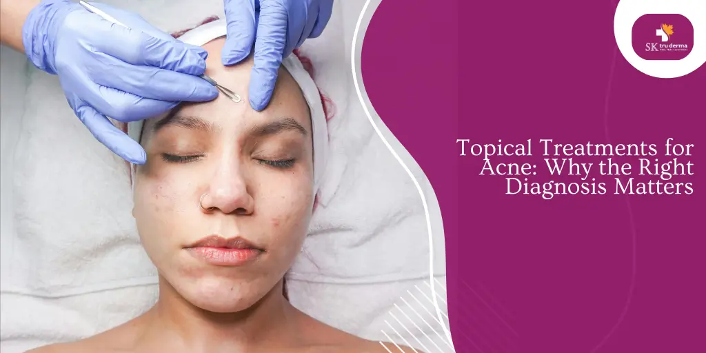 Topical Treatments for Acne: Why the Right Diagnosis Matters | Acne Skin Treatment Gunjur Road
