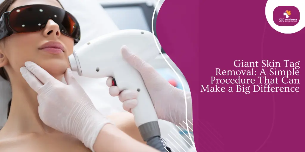 Giant Skin Tag Removal: A Simple Procedure That Can Make a Big Difference | Skin tag removal Clinic in Sarjapur Road