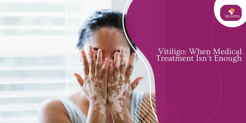 Vitiligo: When Medical Treatment Isn’t Enough | Skin clinic in Gunjur Road, Bangalore